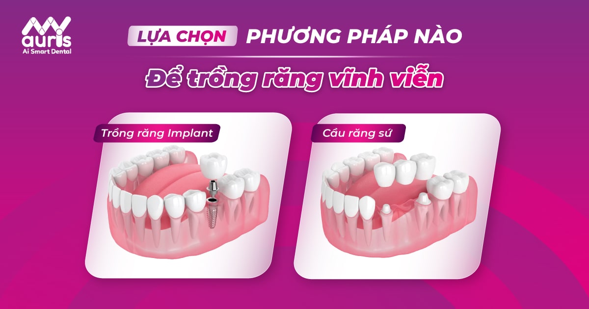 chi phí trồng răng vĩnh viễn