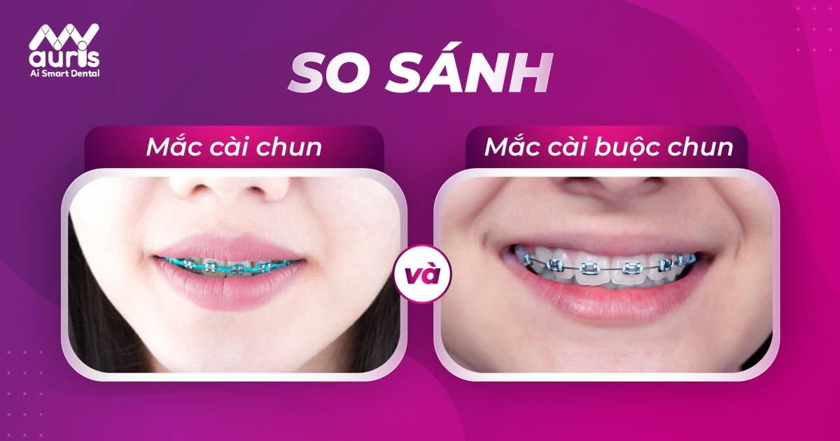 Có những phương pháp niềng răng nào khác ngoài niềng răng mắc cài buộc chun?
