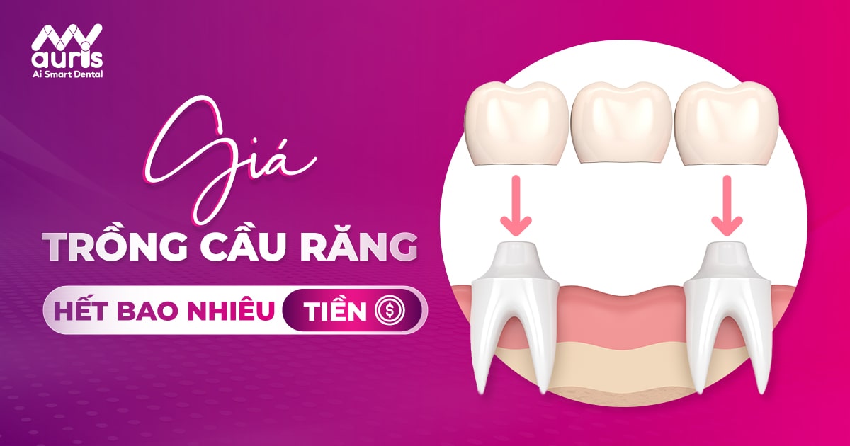 giá trồng răng bắc cầu