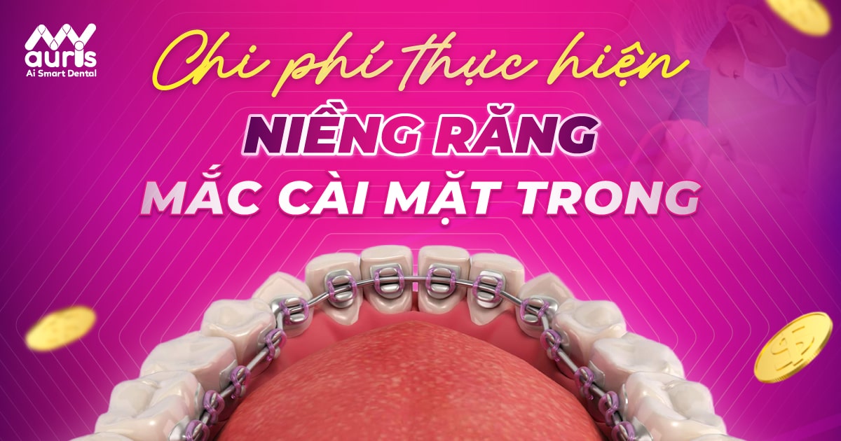 giá niềng răng mắc cài mặt trong