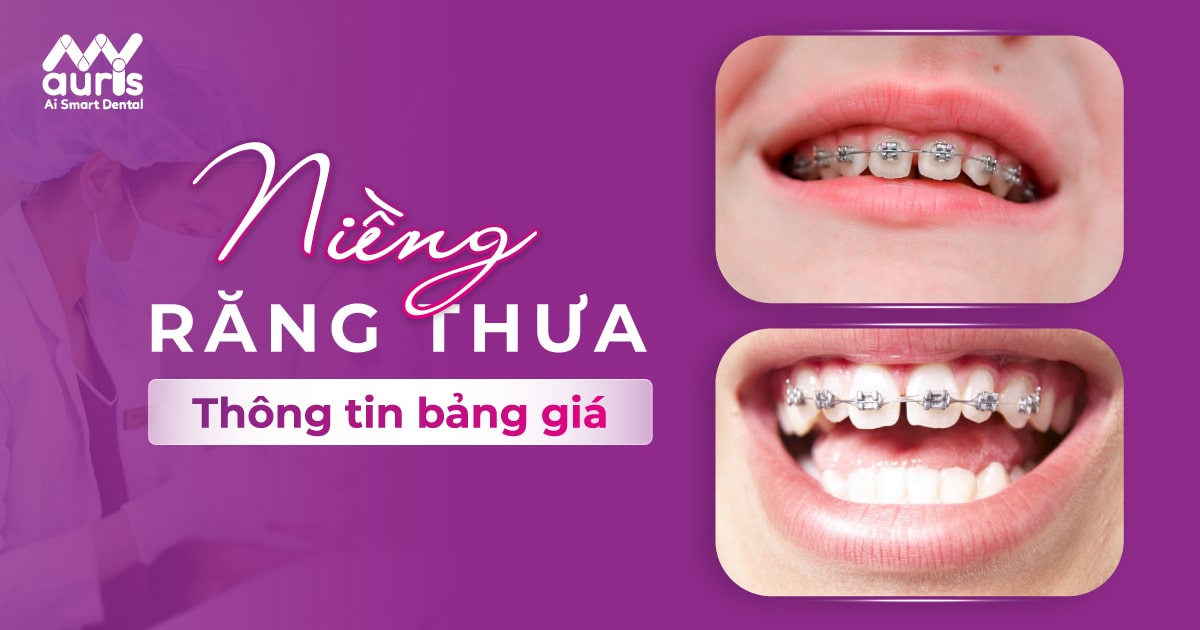 Bảng giá niềng răng thưa và những điều cần biết