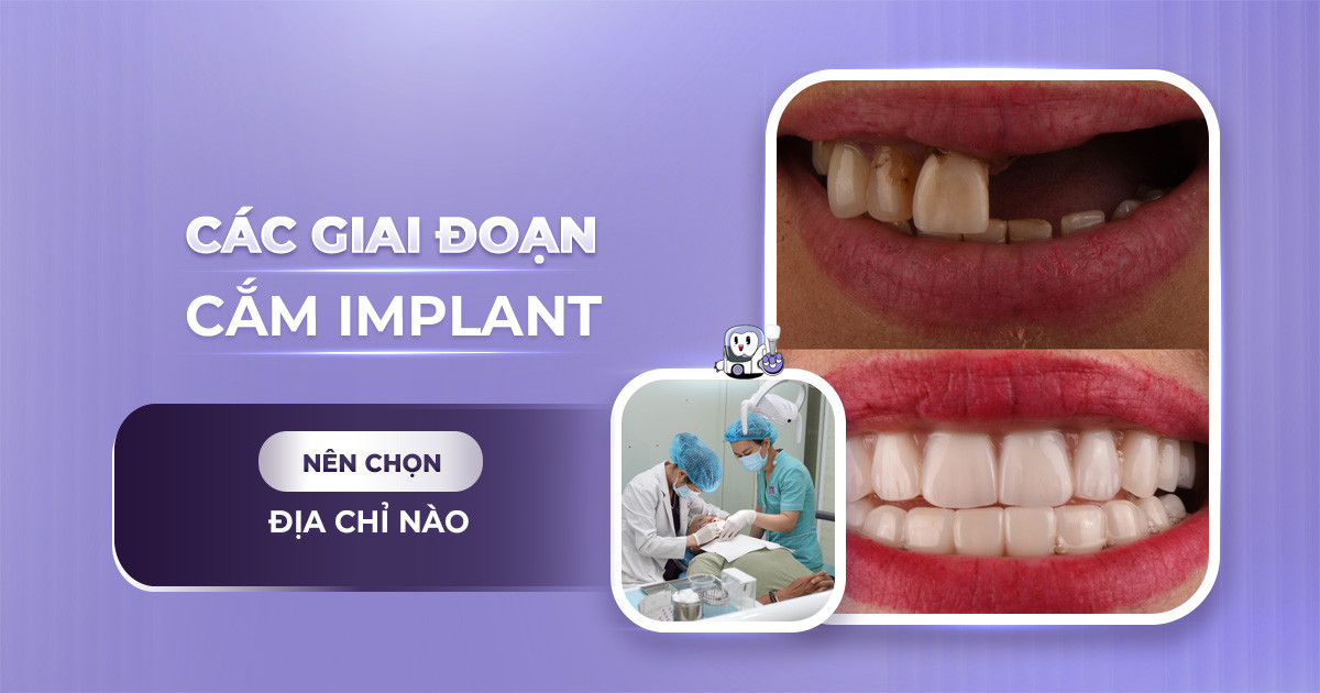 các giai đoạn cắm implant,các giai đoạn trồng răng implant