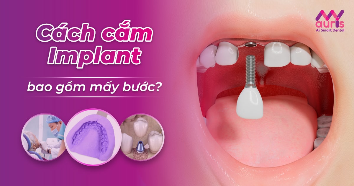 Cách cắm Implant bao gồm mấy bước và cần lưu ý gì?