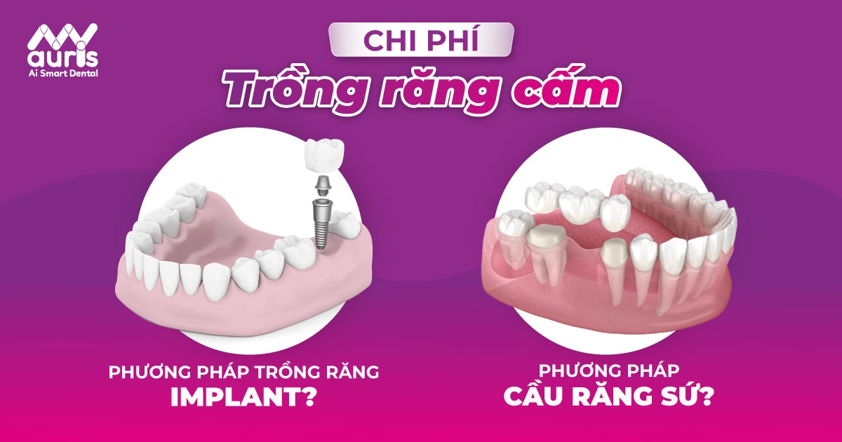 Chi phí trồng răng cấm bao nhiêu với 2 phương pháp chính