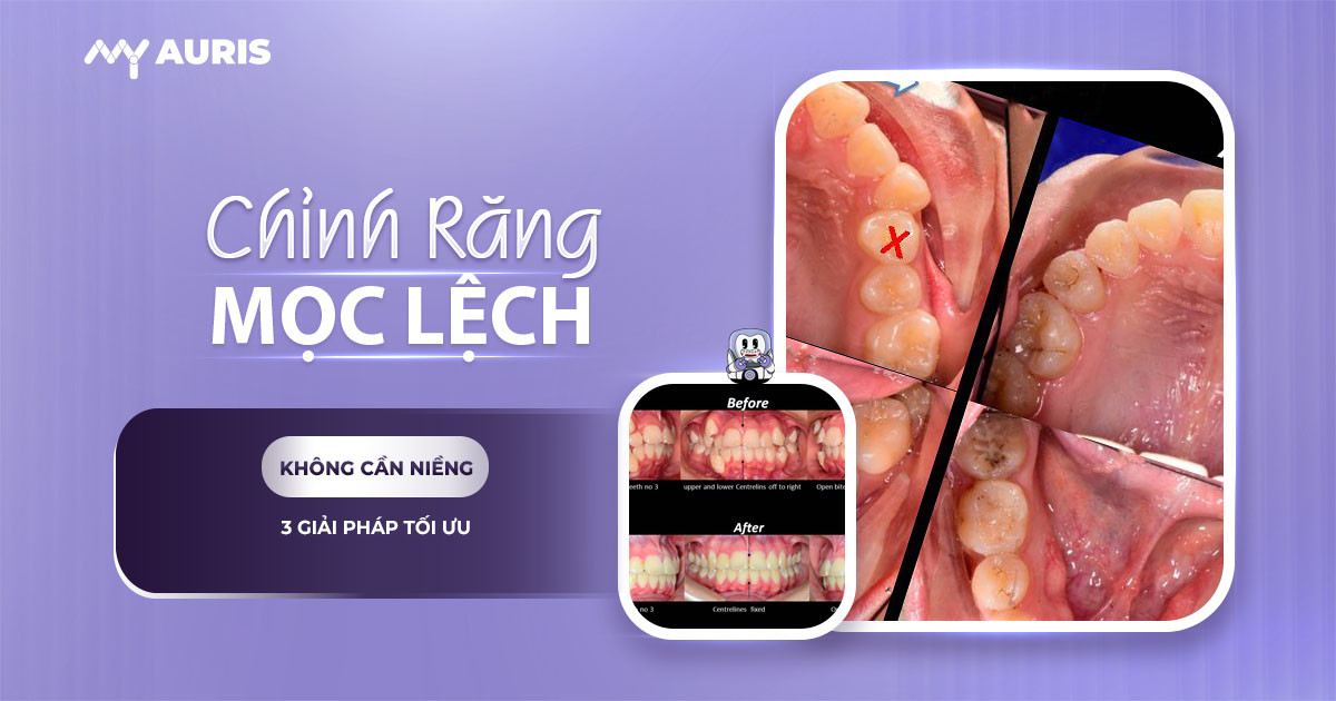 chỉnh răng mọc lệch không cần niềng,cách chỉnh răng mọc lệch tại nhà,chỉnh 1 răng lệch