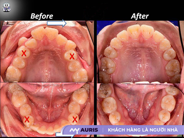 chỉnh răng mọc lệch không cần niềng,cách chỉnh răng mọc lệch tại nhà,chỉnh 1 răng lệch