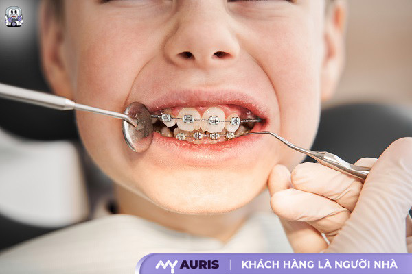 giá niềng răng cho trẻ 10 tuổi