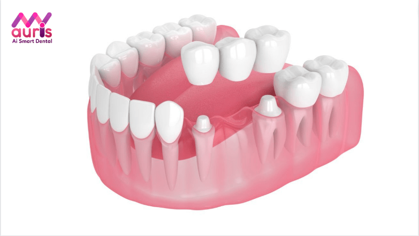 kỹ thuật trồng cầu răng sứ