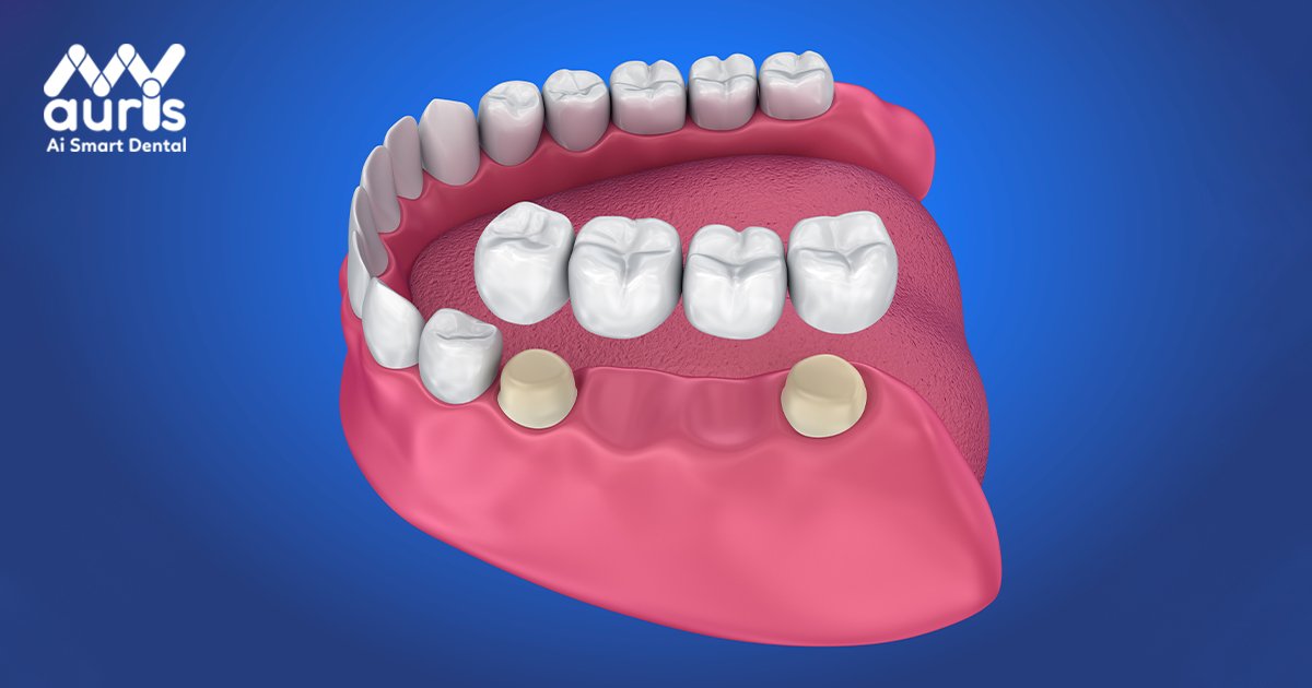 Ưu điểm của trồng răng bắc cầu