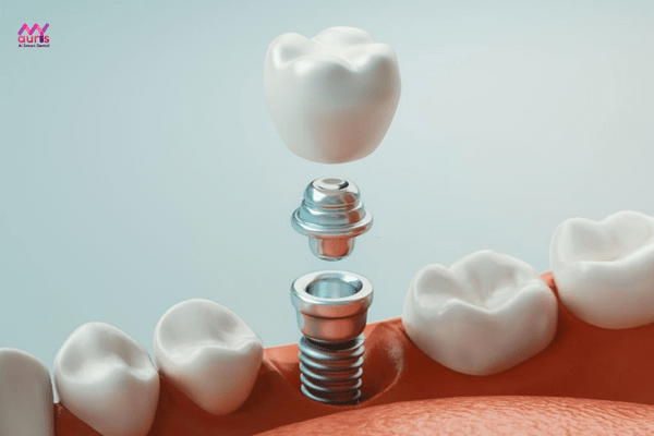 giá trồng răng bình thường