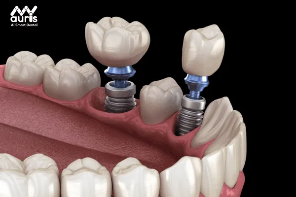 Cắm trụ chân răng Implant giá bao nhiêu tiền? - Cấy ghép Implant là kỹ thuật gì?
