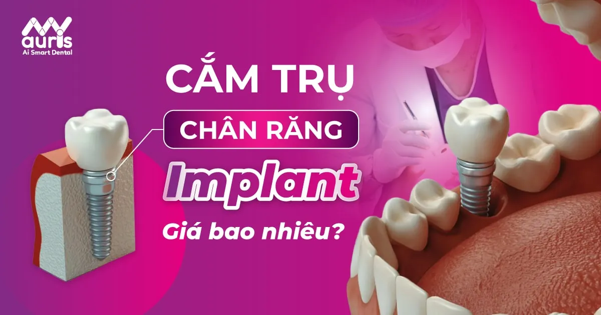 Giải đáp cắm trụ chân răng Implant giá bao nhiêu tiền?