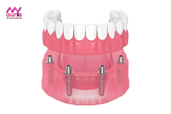Trồng răng giả có niềng được không với phương pháp Implant hàm tháo lắp