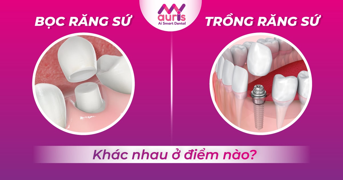 Bọc răng sứ và trồng răng sứ có giá cả như thế nào?

Article Title: Bọc răng sứ và trồng răng sứ: Những điểm quan trọng cần biết
Introduction: Giữa hai phương pháp phục hình răng là bọc răng sứ và trồng răng sứ, bạn đã hiểu rõ sự khác biệt giữa chúng chưa? Trong bài viết này, chúng ta sẽ tìm hiểu về hai phương pháp này, từ quá trình thi công, ưu điểm, nhược điểm, và cách chăm sóc sau khi đã bọc hoặc trồng. Cùng khám phá chi tiết về bọc răng sứ và trồng răng sứ, để tìm hiểu xem phương pháp nào phù hợp với nhu cầu của bạn nhé!