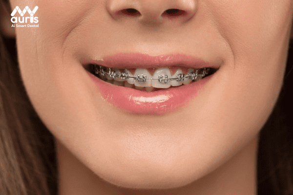 Niềng răng mắc cài kim loại thuộc nhóm các phương pháp niềng răng ăn toàn