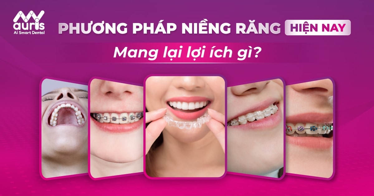 Tổng hợp các phương pháp niềng răng hiện nay