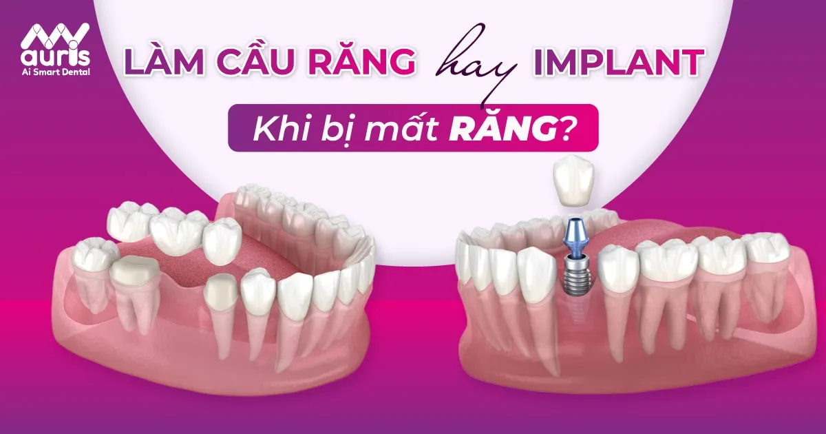 Nên làm cầu răng hay Implant khi bạn bị mất răng?