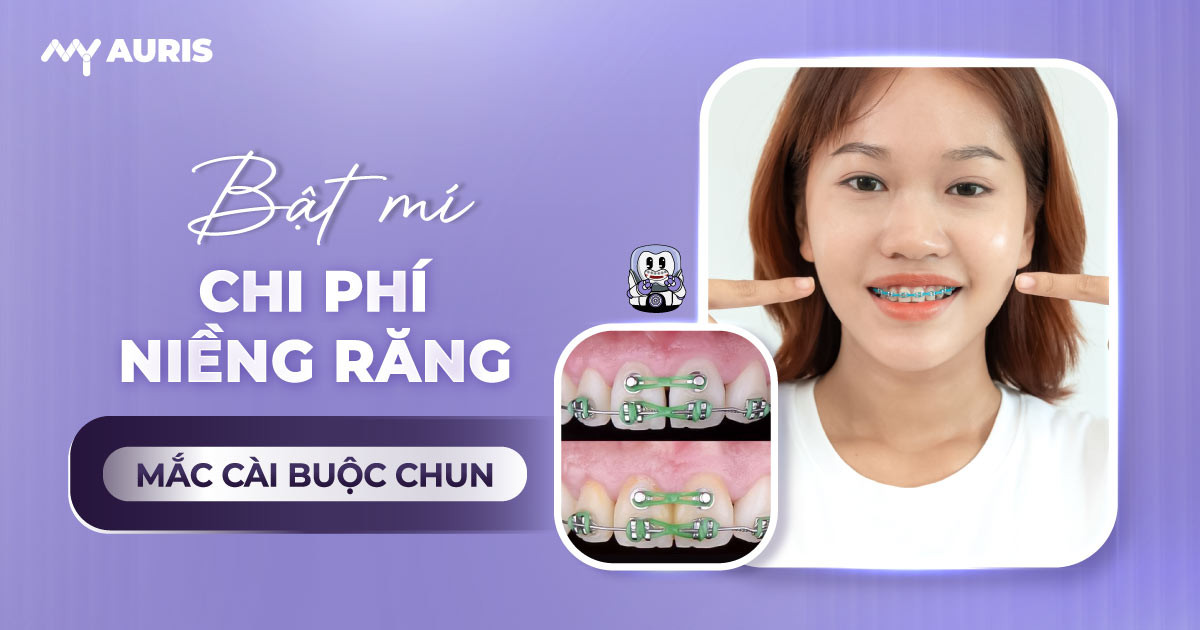 niềng răng mắc cài buộc chun,niềng răng mắc cài chun
