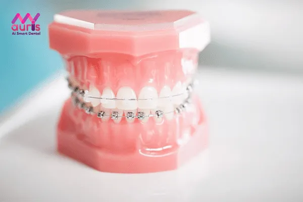 Niềng răng mắc cài nào tốt? - So sánh giữa hai phương pháp