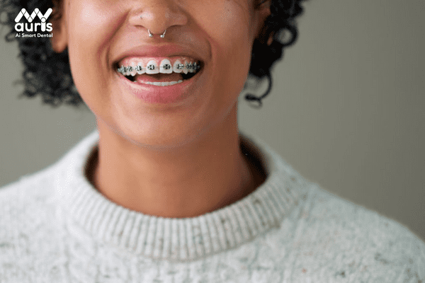 Niềng răng với mắc cài kim loại là gì?
