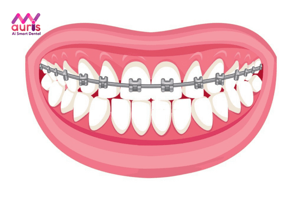 Tìm hiểu thông tin kỹ thuật niềng răng mắc cài thông minh là gì?