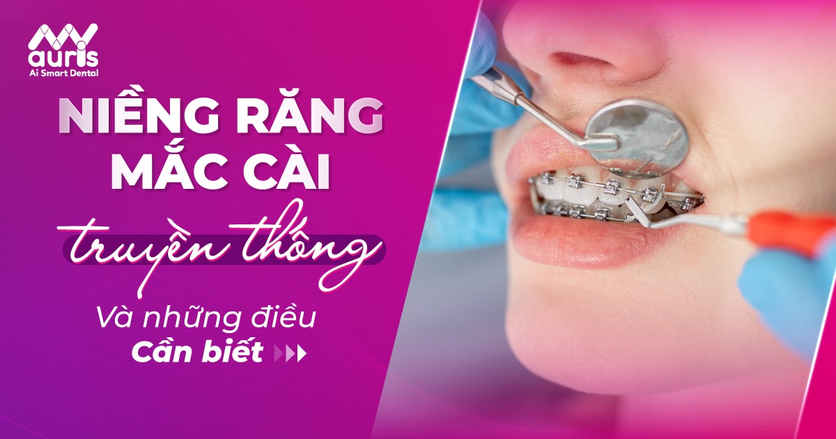 niềng răng mắc cài truyền thống