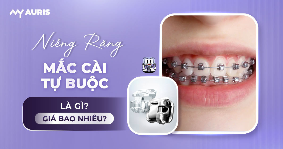 niềng răng mắc cài tự buộc