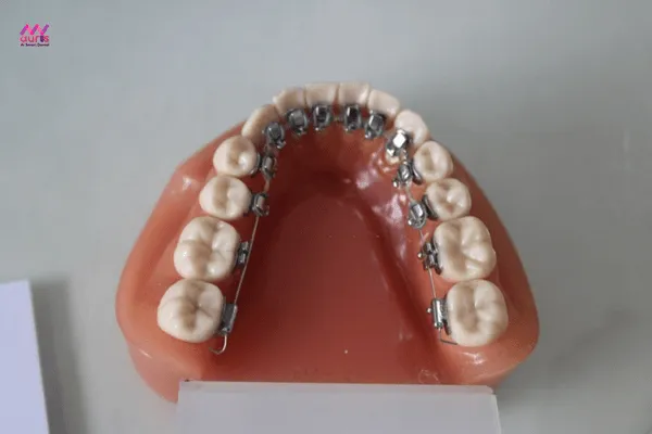 niềng răng mặt trong 1 hàm