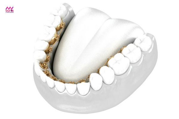 niềng răng mặt trong 1 hàm