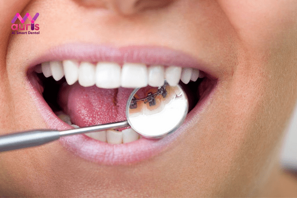 Niềng răng mặt trong trả góp - Sức khỏe là yếu tố ảnh hưởng