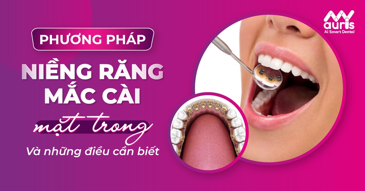 phương pháp niềng răng mắc cài mặt trong