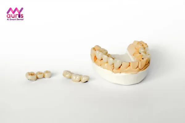 Trồng răng khểnh giả bằng kỹ thuật cầu răng sứ