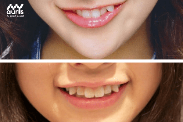 Tại sao nhiều người thích trồng răng khểnh?