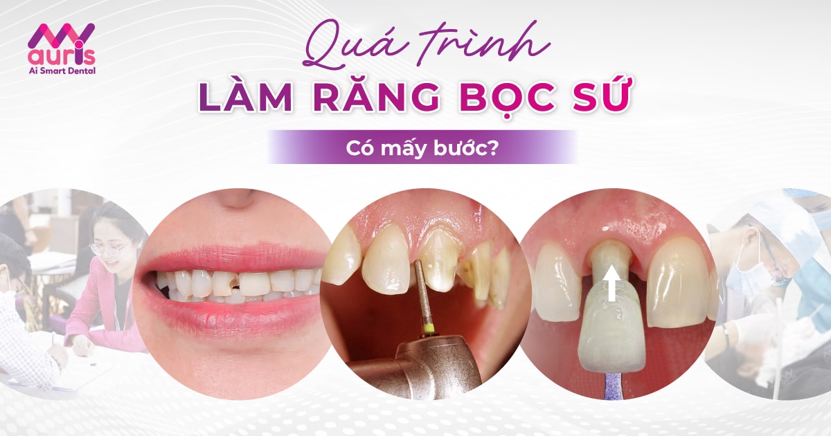 Quá trình làm răng bọc sứ bao gồm mấy bước chính?