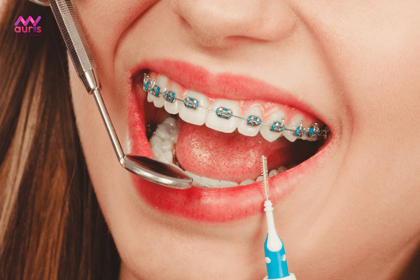 quy trình niềng răng mắc cài