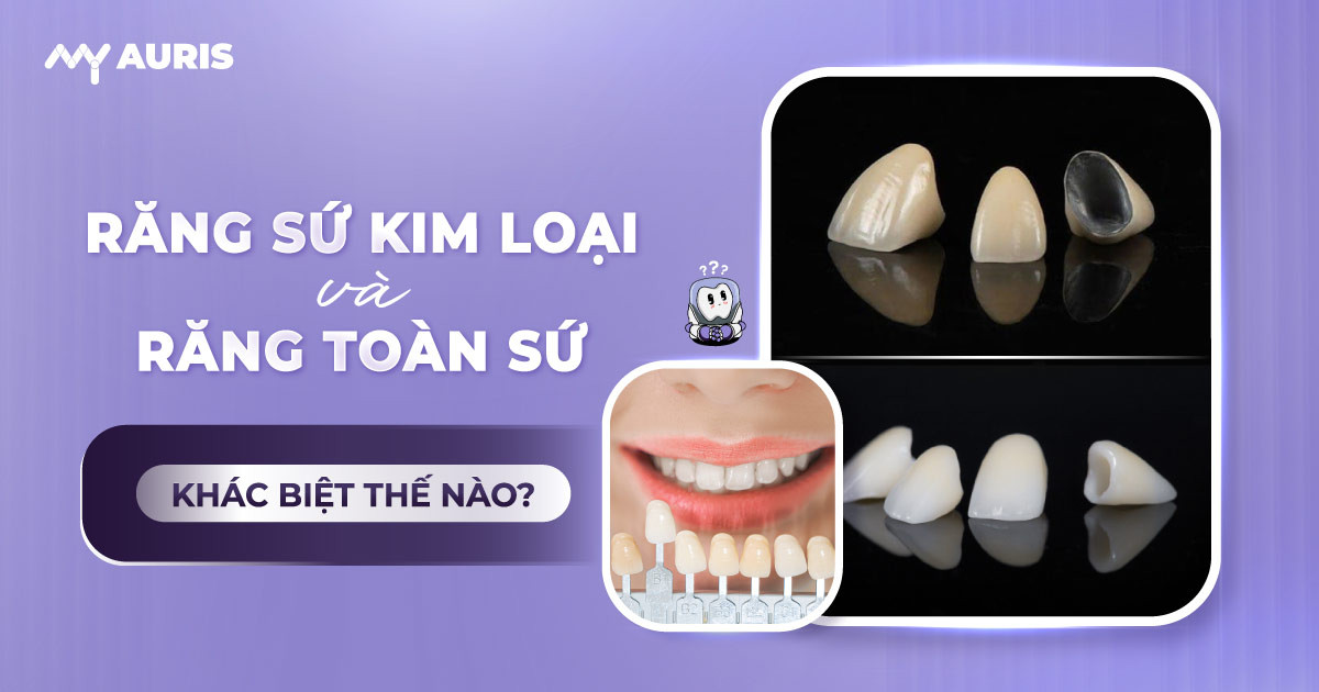 Răng sứ kim loại và răng toàn sứ