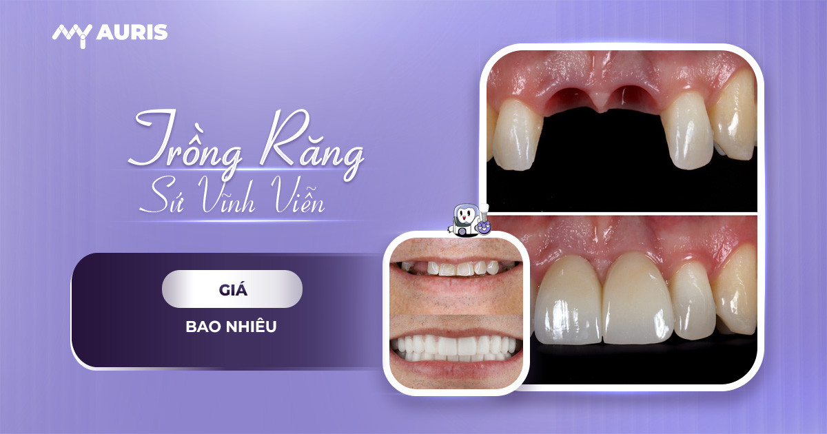 Trồng răng sứ vĩnh viễn giá bao nhiêu