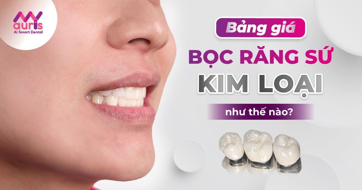 bảng giá bọc răng sứ kim loại