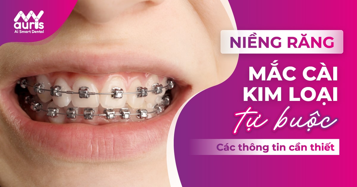 Niềng răng mắc cài kim loại tự buộc những điều cần biết