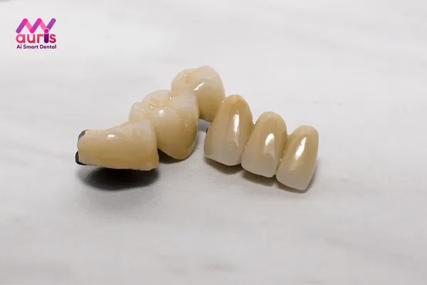 Răng sứ Titan là răng gì?