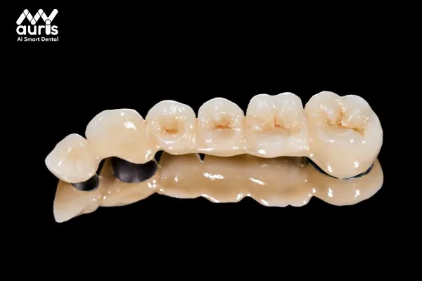 Cấu tạo răng sứ Titan gồm những phần nào?
