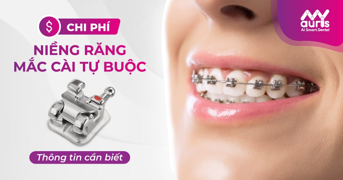 Tìm hiểu thông tin chi phí niềng răng mắc cài tự buộc