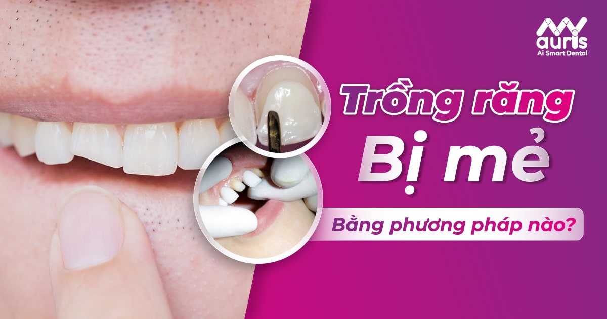 Trồng răng bị mẻ bằng những phương pháp nào hiệu quả?