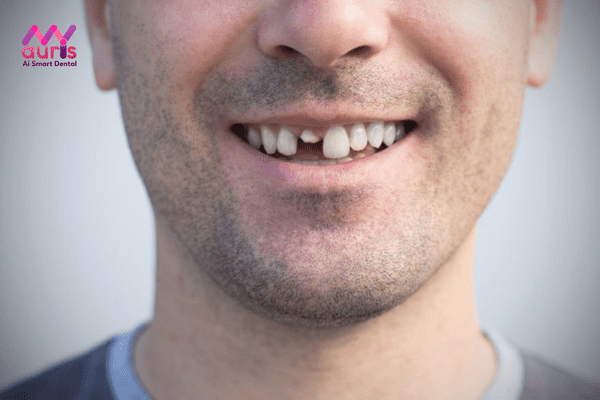 Răng gãy vỡ nhưng còn chân răng được hiểu như thế nào?