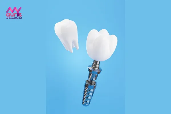 Trồng răng cùng phương pháp trồng răng Implant