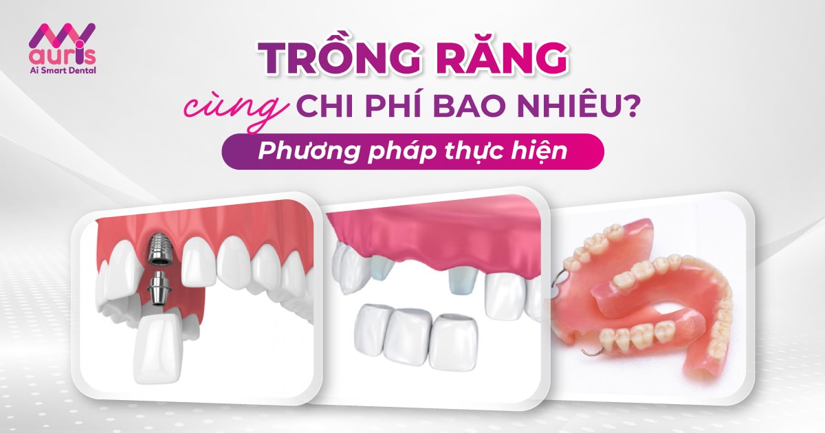 Giải đáp trồng răng cùng với chi phí bao nhiêu hợp lý?