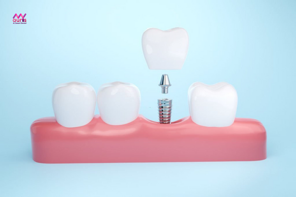 trồng răng implant 4s