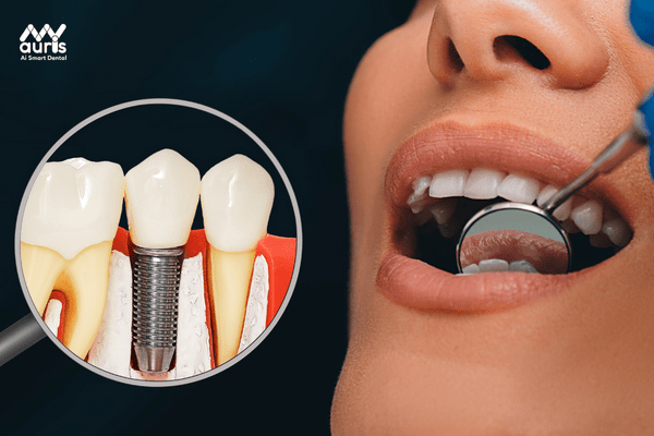 trồng răng implant 4s