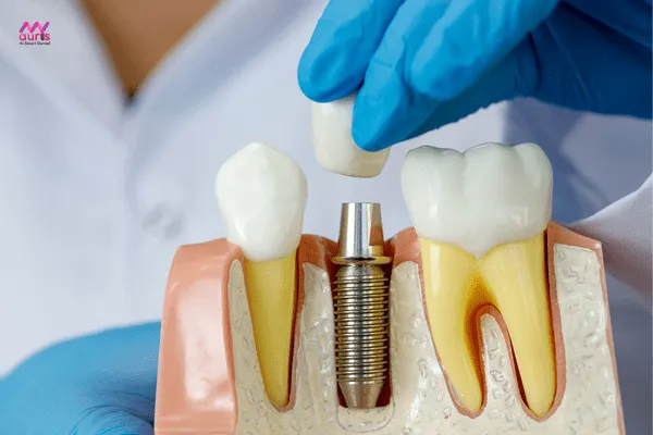  trồng răng implant khuyến mãi