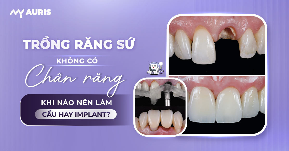 trồng răng sứ không có chân răng,trồng răng không có chân răng